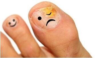 Ciuperca Unghiilor De La Picioare și A Unghiilor - Simptome, Tratament, Cauze | Boli 